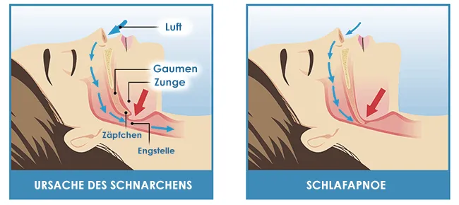 Schnarchen schlafapnoe